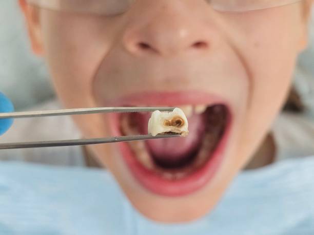 Best Emergency Tooth Extraction in Salyersville, KY